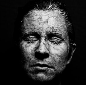 腋臭症のミラドライと代償性発汗の手術の違いは何ですか？